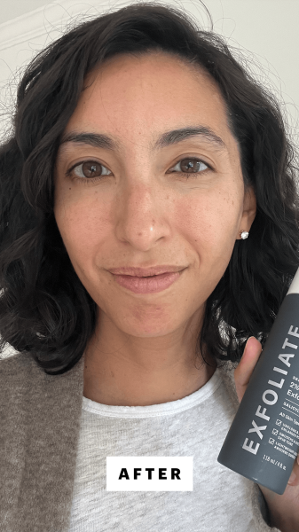 Pai after applying Paulas Choice Skin Perfecting 2 BHA Liquid Exfoliant